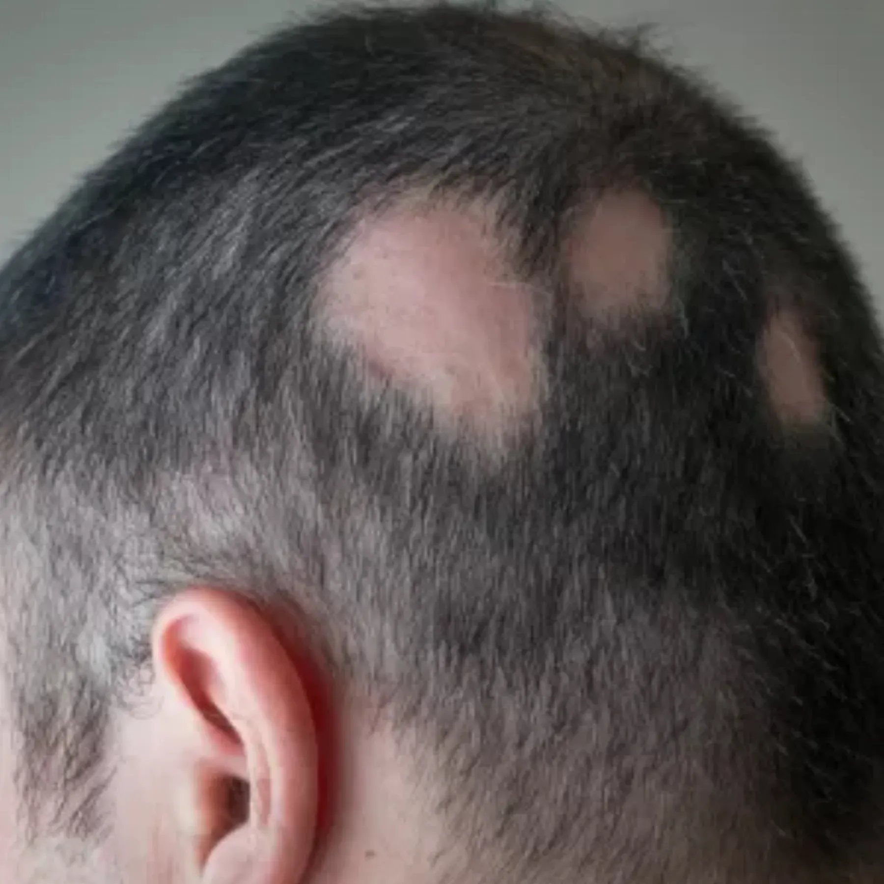 Alopecia areata — antes do acompanhamento capilar
