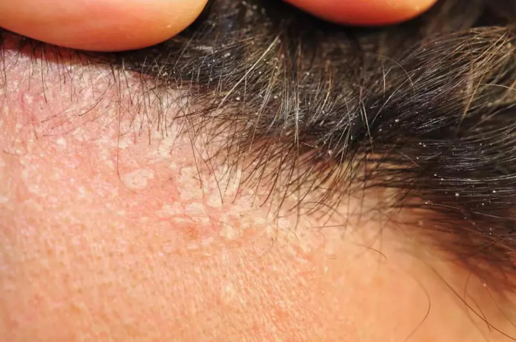 Tratamento para dermatite seborreica no instituto