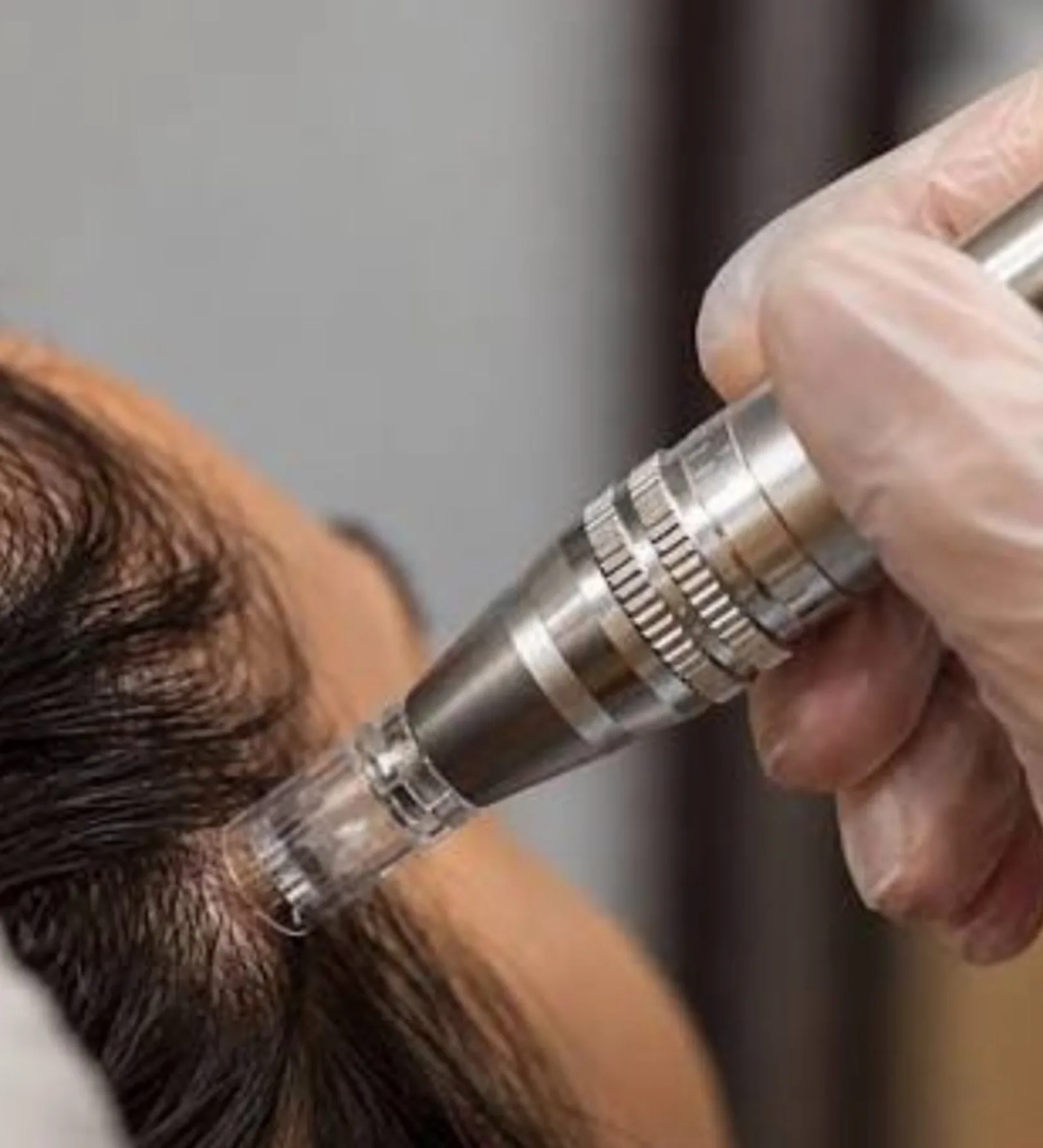 Microagulhamento — dermapen aplicado no couro cabeludo